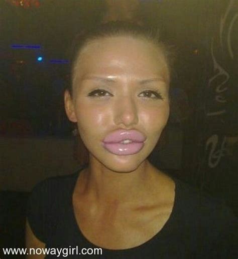 why are so many women getting fake lips
